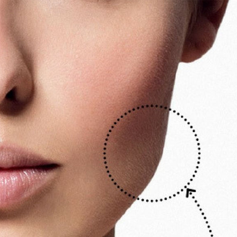 درباره بوکال فت (تخلیه چربی زیرگونه) چه میدانید؟