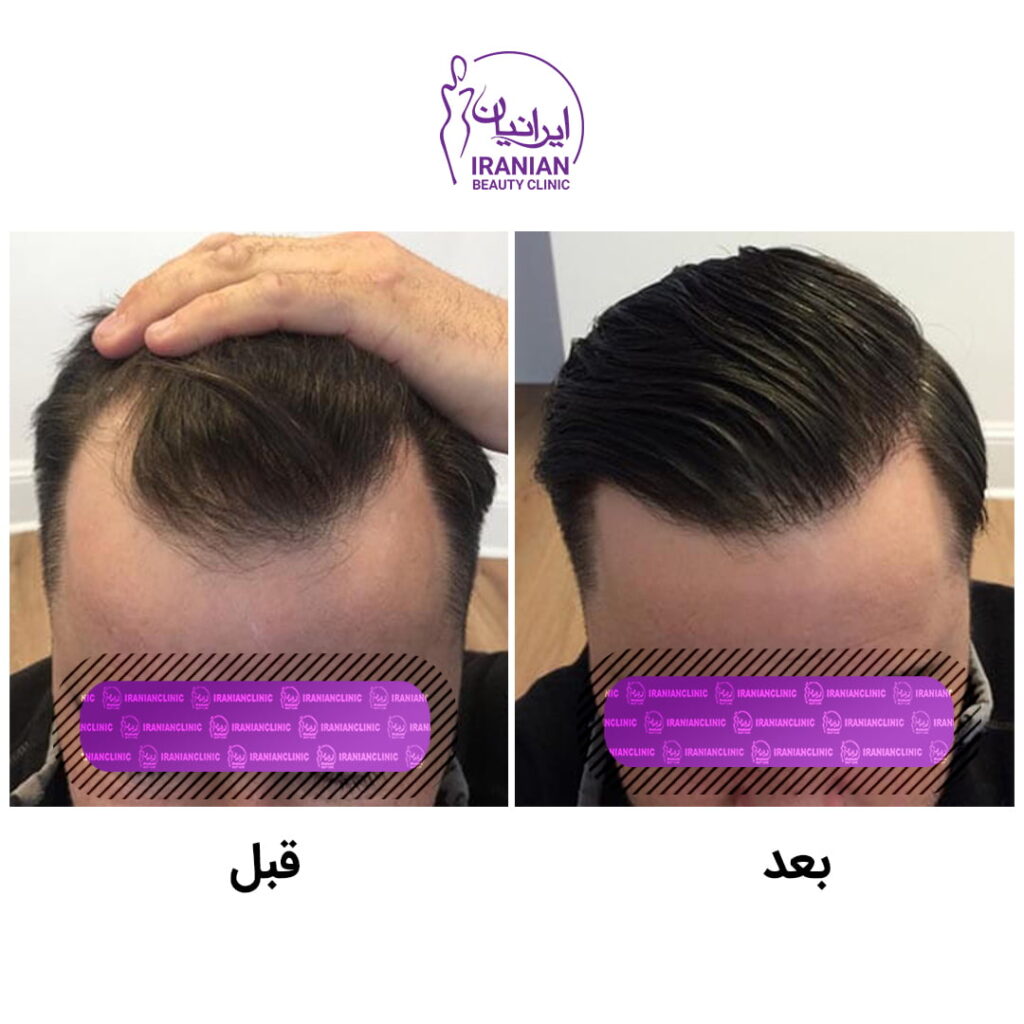 بهترین کلینیک (مرکز) کاشت مو تهران کجاست؟