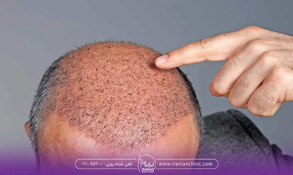 بهترین فصل و زمان کاشت مو زمستان است یا تابستان؟