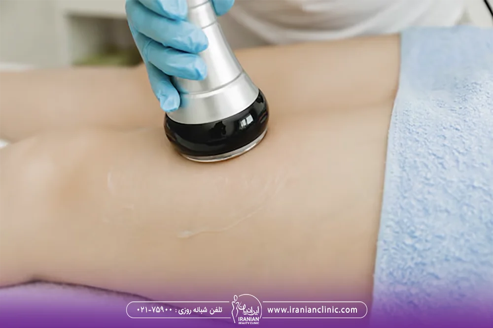اپراتور دستگاه Cavitation که هندپیس را روی ران فرد قرار داده است