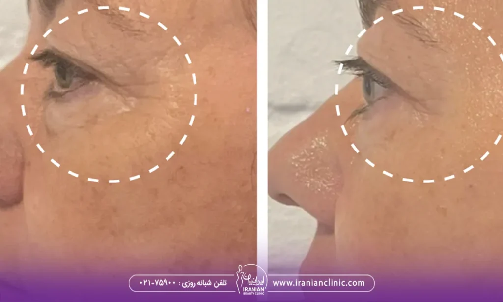 خانمی در حال هایفوتراپچی دور چشم برای از بین بردن چروک دور چشم وتیرگی ان، هایفوتراپی دور چشم