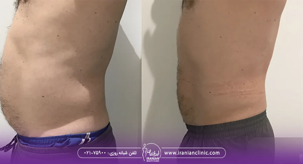 عکس قبل و بعد لاغری با کویتیشن