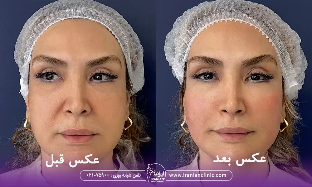 عکس خانمی که هایفوتراپی صورت انجام داده در کلینیک زیبایی ایرانیان، عکس قبل و بعد هایفوتراپی خط خنده و صورت
