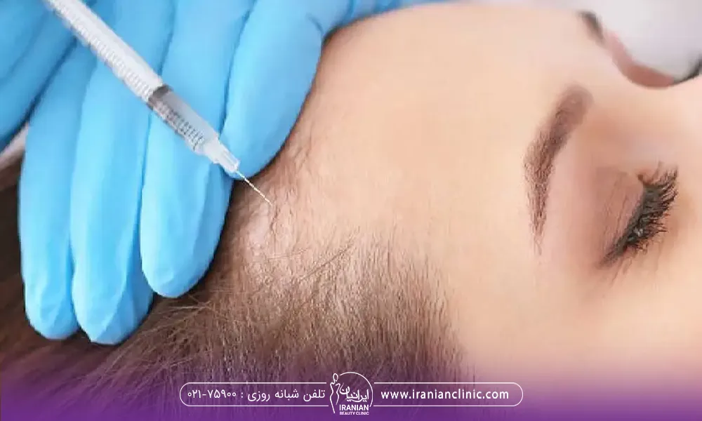 یک خانم که خوابیده است و پزشکی که با دستکش آبی در حال تزریق مزوتراپی مو است