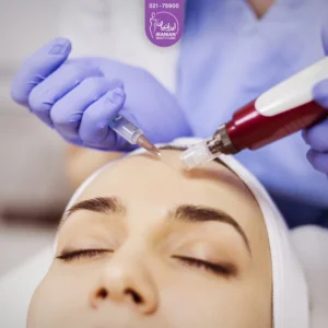 مزوتراپی پیشانی دختر توسط پزشک با میکرونیدلینگ و آمپول مزو - مزوتراپی صورت