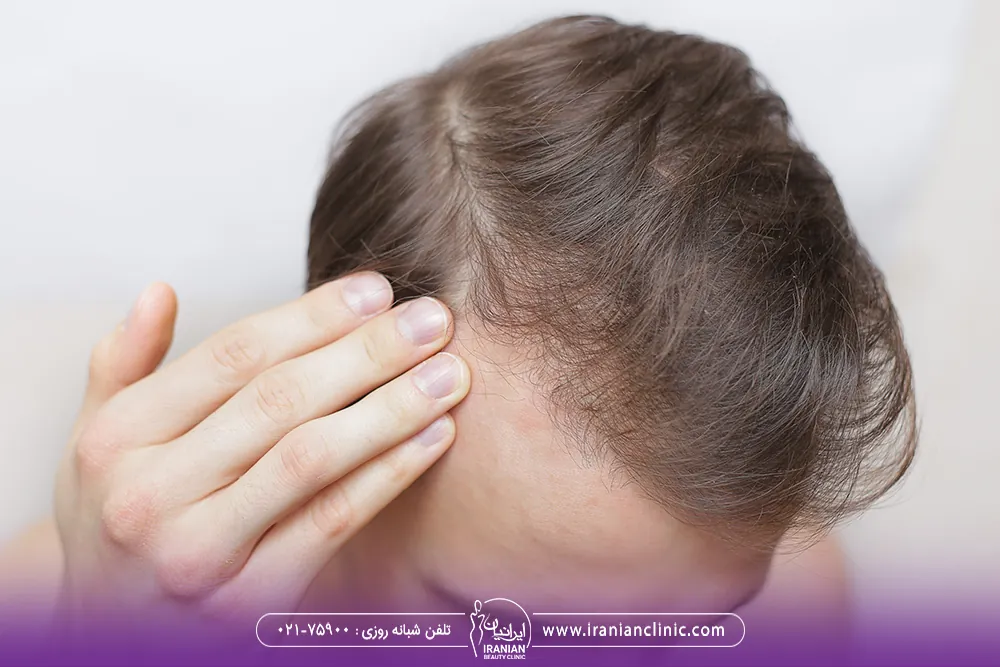 مرد جوان که در اطراف شقیقه ها دچار ریزش مو شده است
