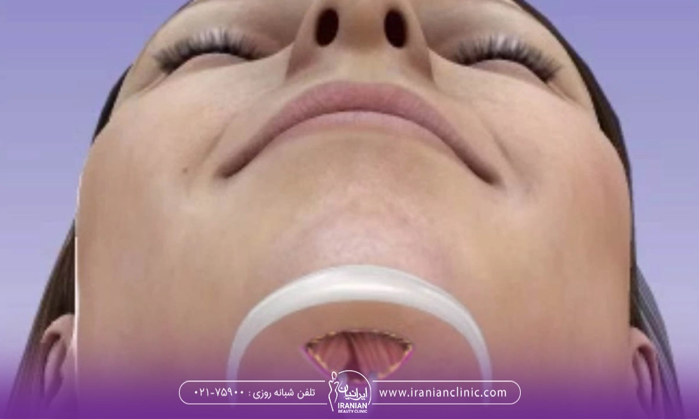 نمایی از انجام پروتز چانه برای یک خانم