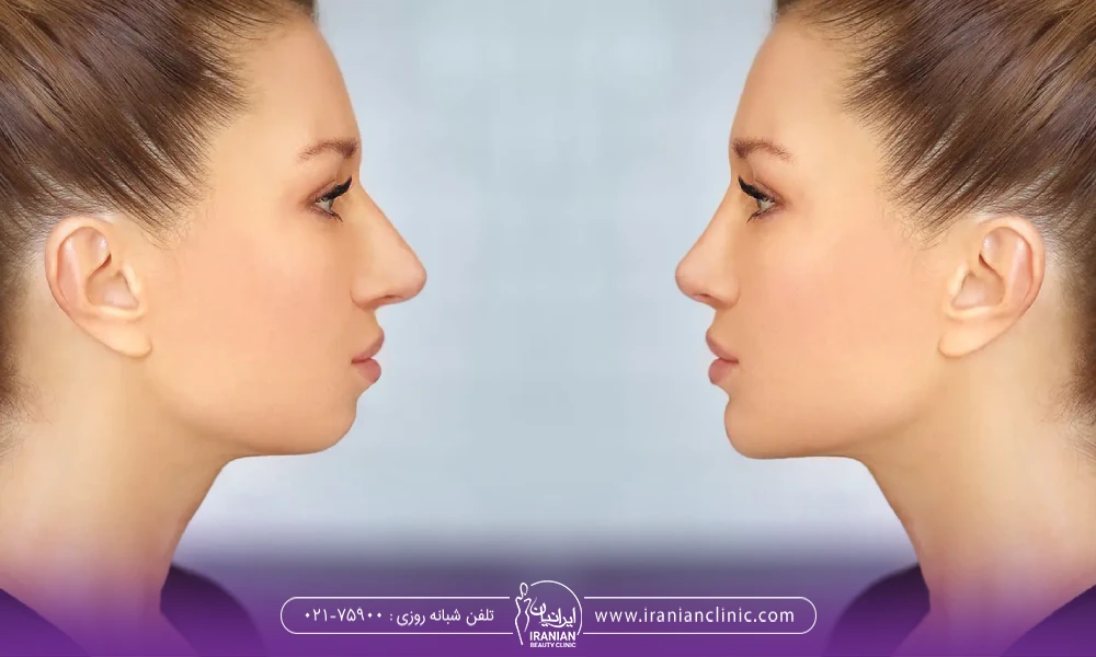 قبل و بعد از انجام پروتز چانه ی یک خانم
