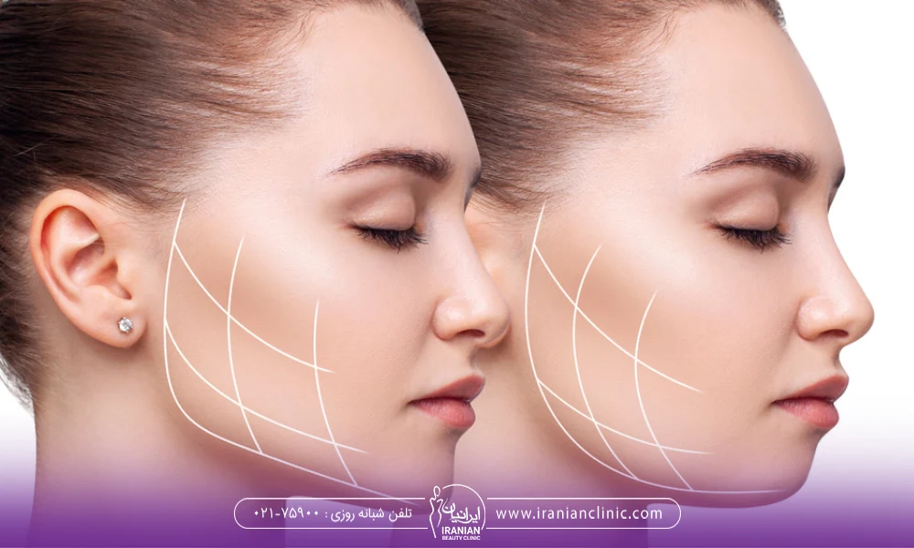 مشخص شدن قسمت پایین گونه یک خانم با خطوط سفید