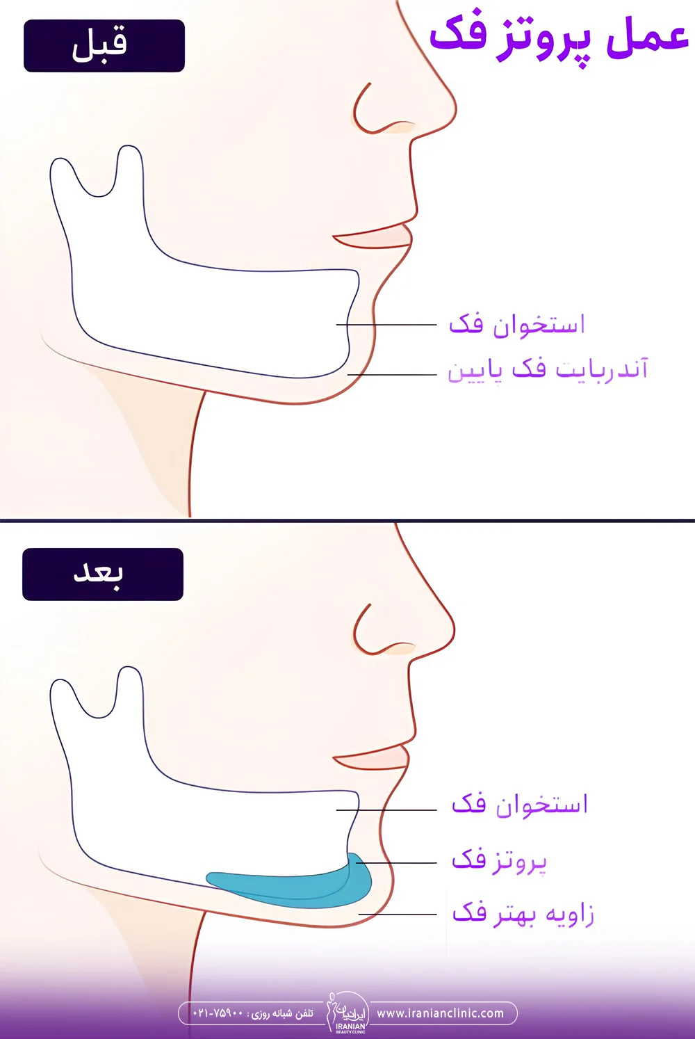 عکس قبل و بعد عمل پروتز فک