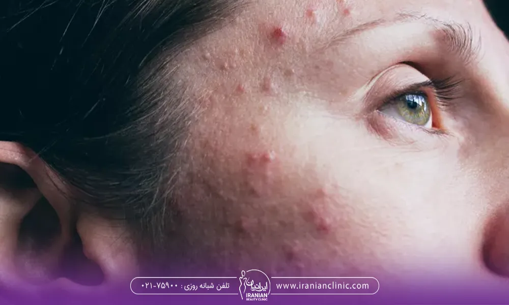 انواع جوش صورت