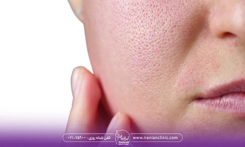 عکس منافذ باز روی پوست صورت