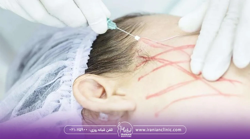 پزشک در حال وارد کردن نخ لیفت داخل پوست صورت مراجعه کننده زن