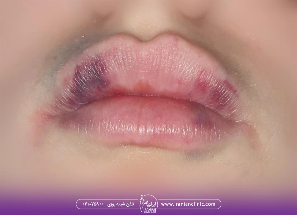 کبودی لب بعد از تزریق ژل لب طبیعی