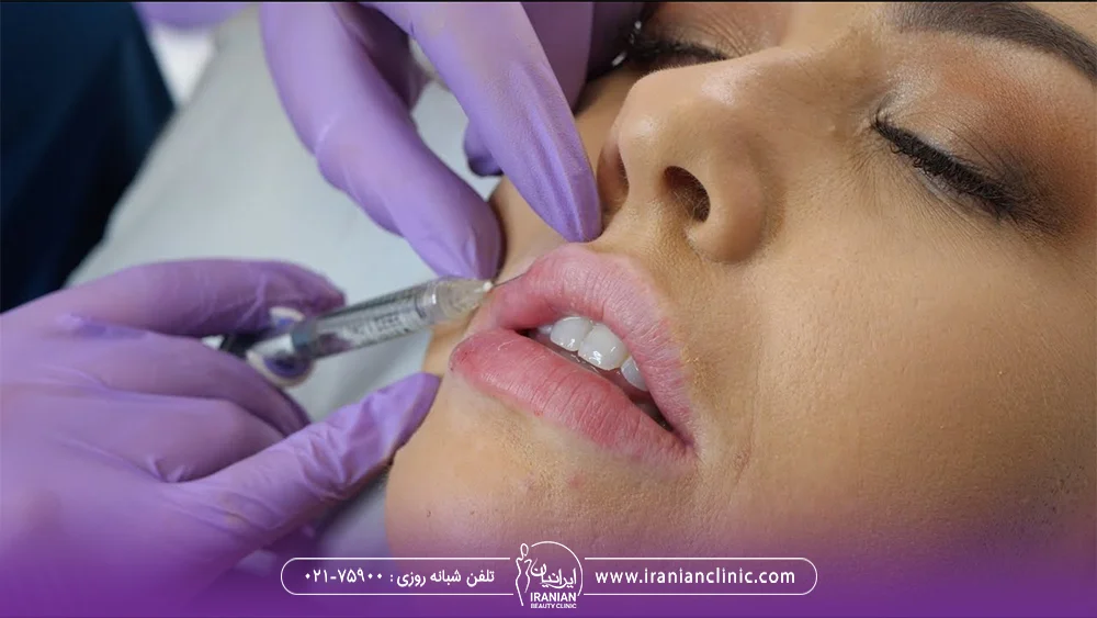 پزشک در حال تزریق ژل هیالورونیک اسید به لب بالای زن