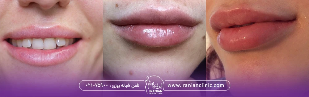 3 عکس مختلف از نمونه های تزریق ژل لب طبیعی