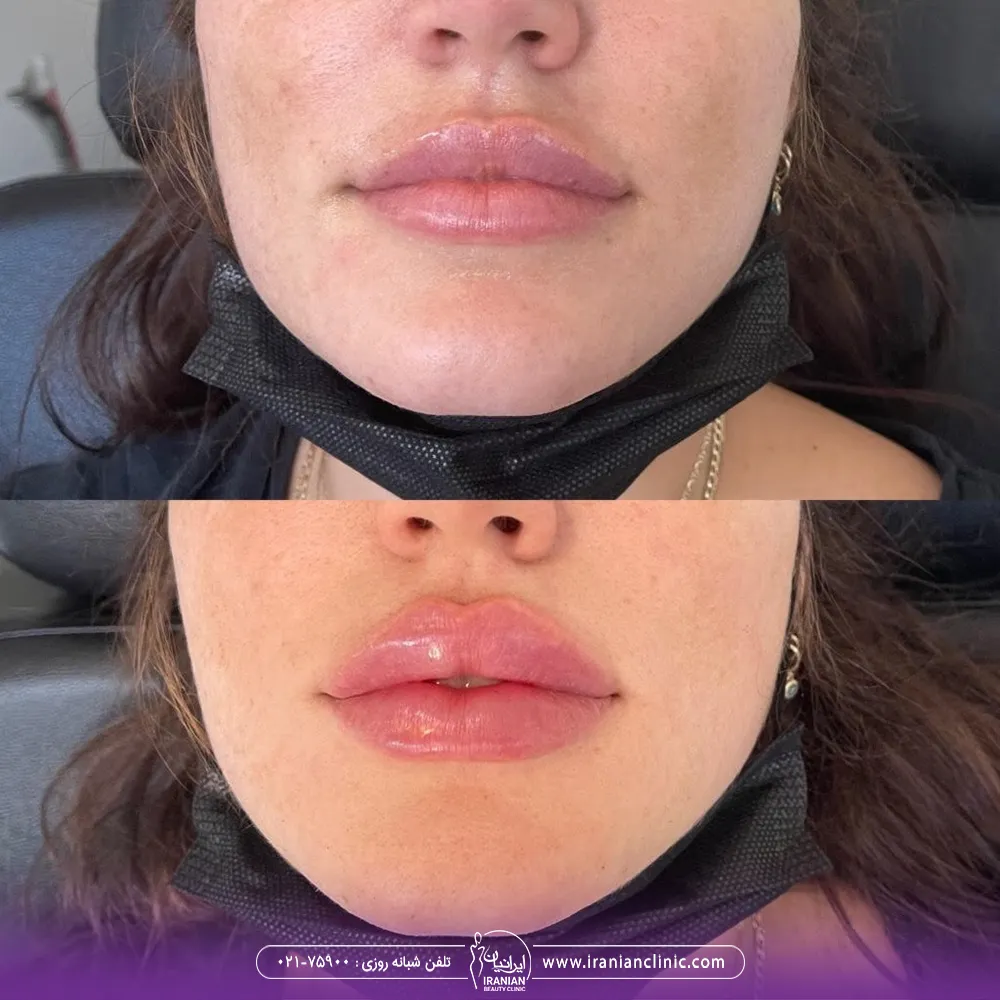 عکس قبل و بعد تزریق ژل به لب به روش روسی