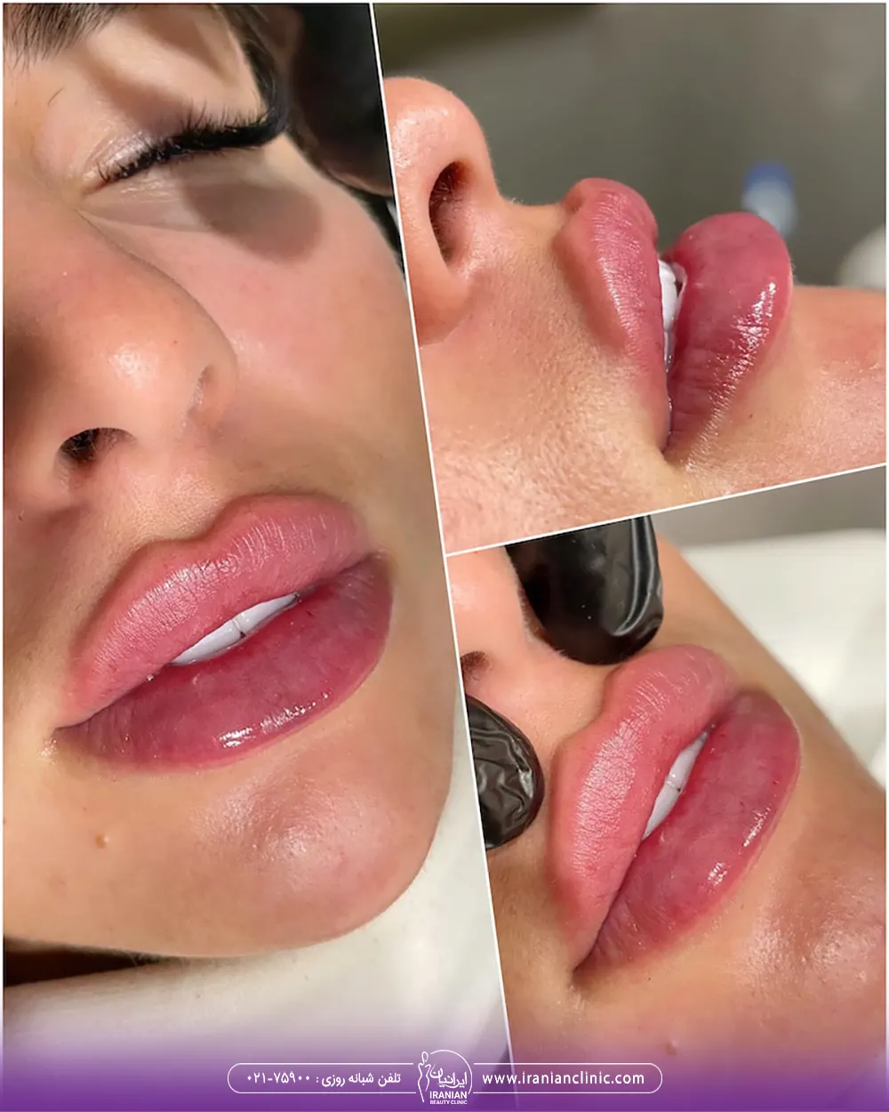 کلاژ عکس نتایج تزریق ژل لب روسی دختر جوان