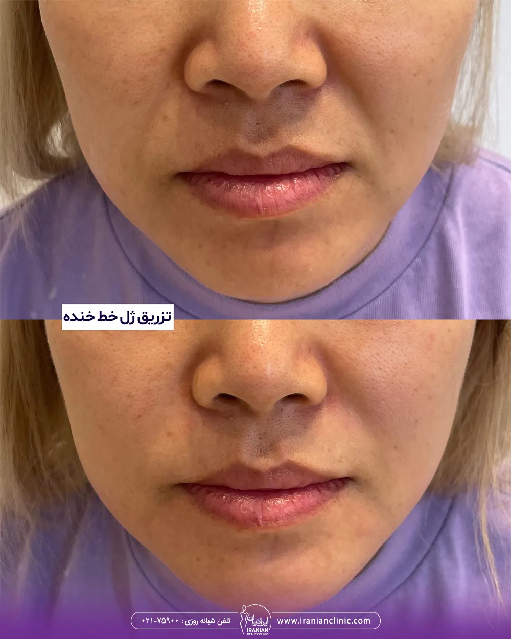 عکس قبل و بعد تزریق ژل خط خنده