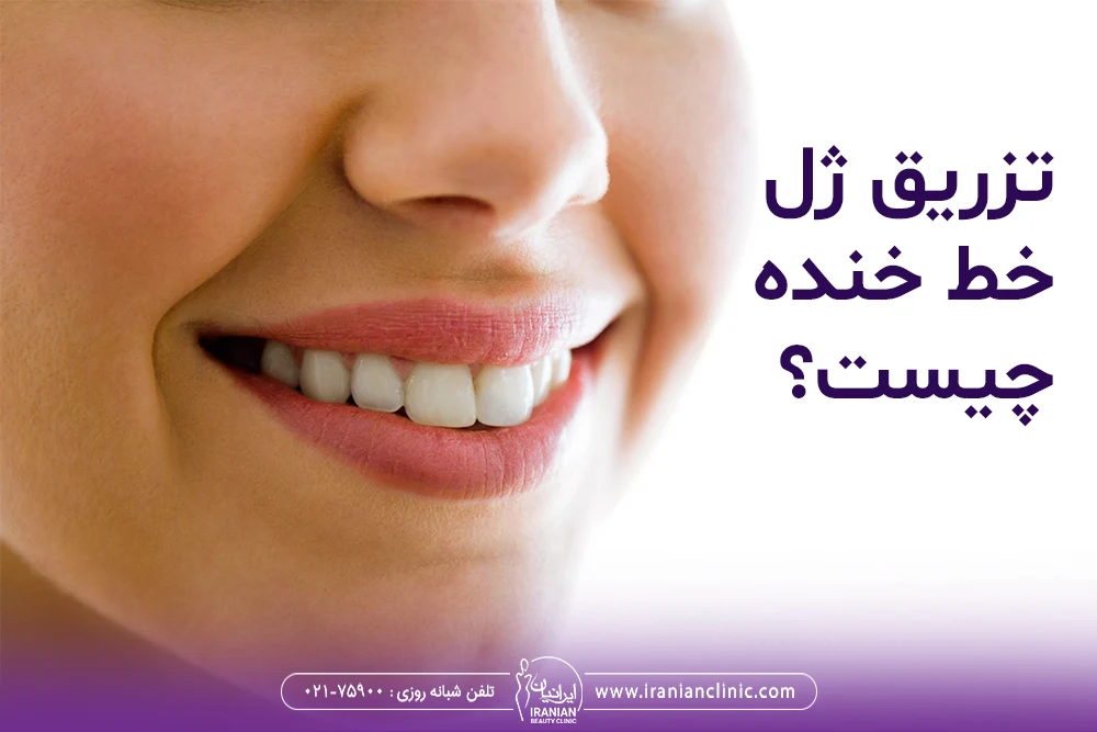 تزریق ژل خط خنده چیست؟