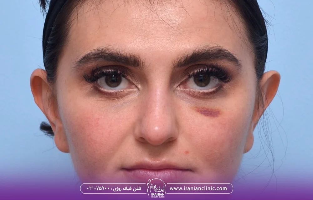 دختری که زیر چشم چپ او کبود شده است