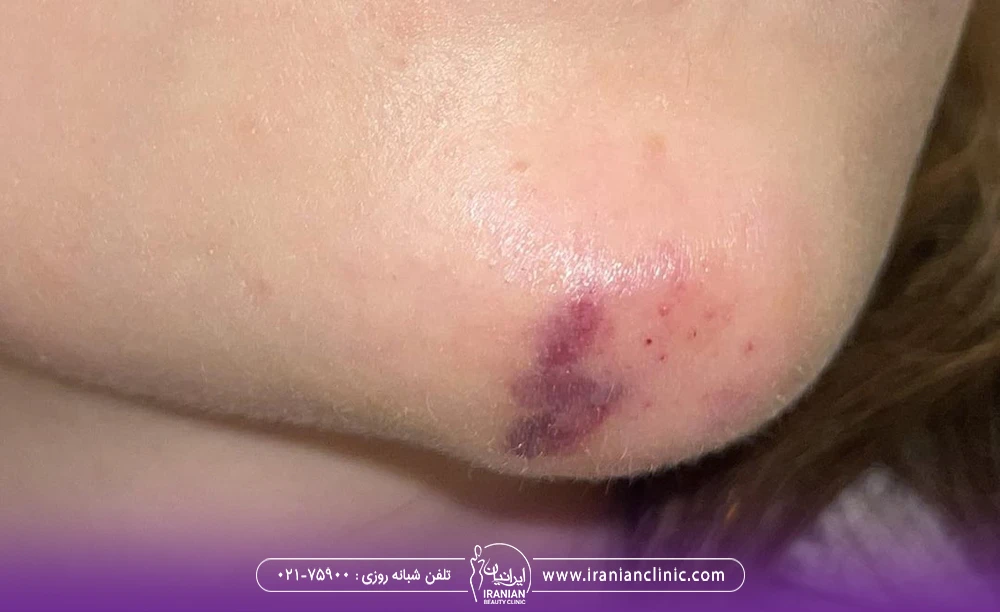 کبودی یکی از عوارض بعد از تزریق فیلر چانه است