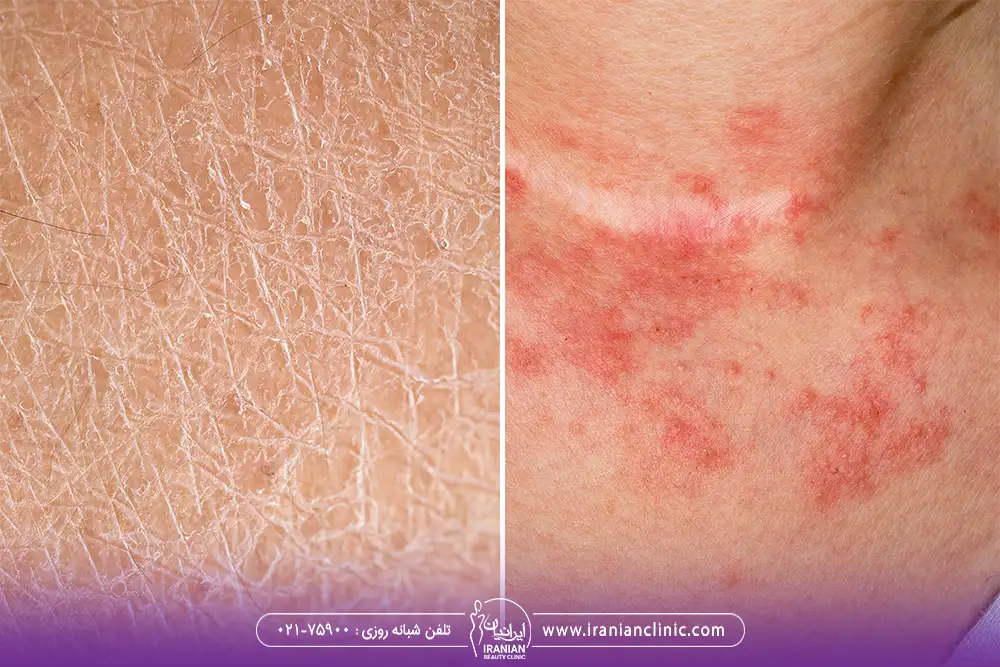 مقایسه پوست خشک و پوست کم آب - آبرسانی پوست
