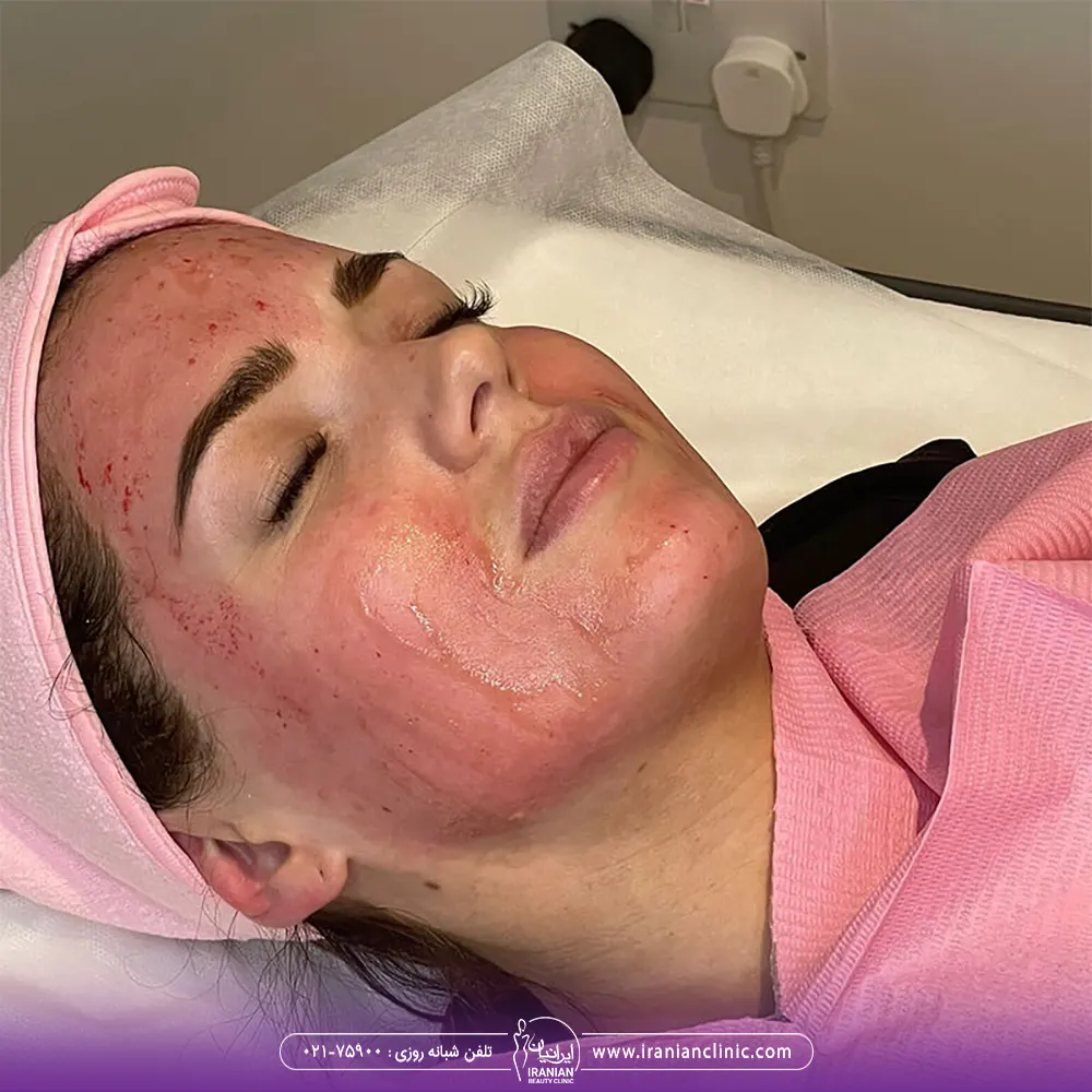 عکس صورت دختر که بعد از مزونیدلینگ قرمز شده و ورم کرده است - مزونیدلینگ