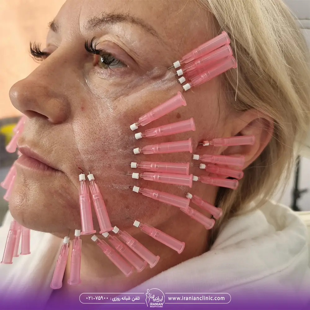 عکس نخ های لیفت که در صورت زن مسن قرار داده شده است