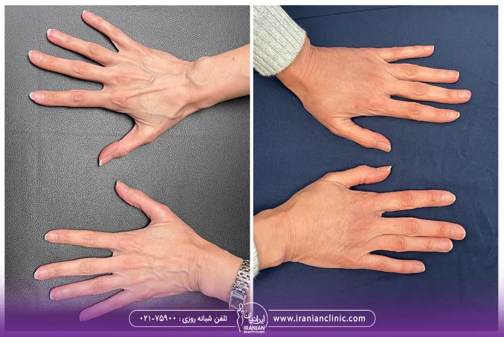 عکس قبل و بعد تزریق چربی به دست