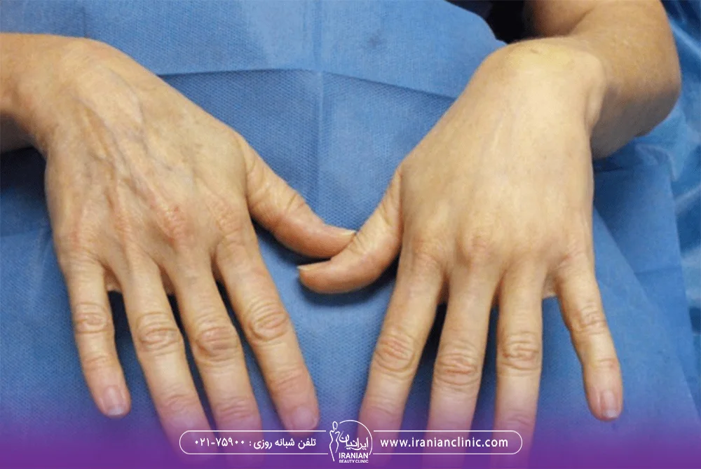 نتیجه تزریق چربی به پشت یکی از دستان در مقابل دست دیگر
