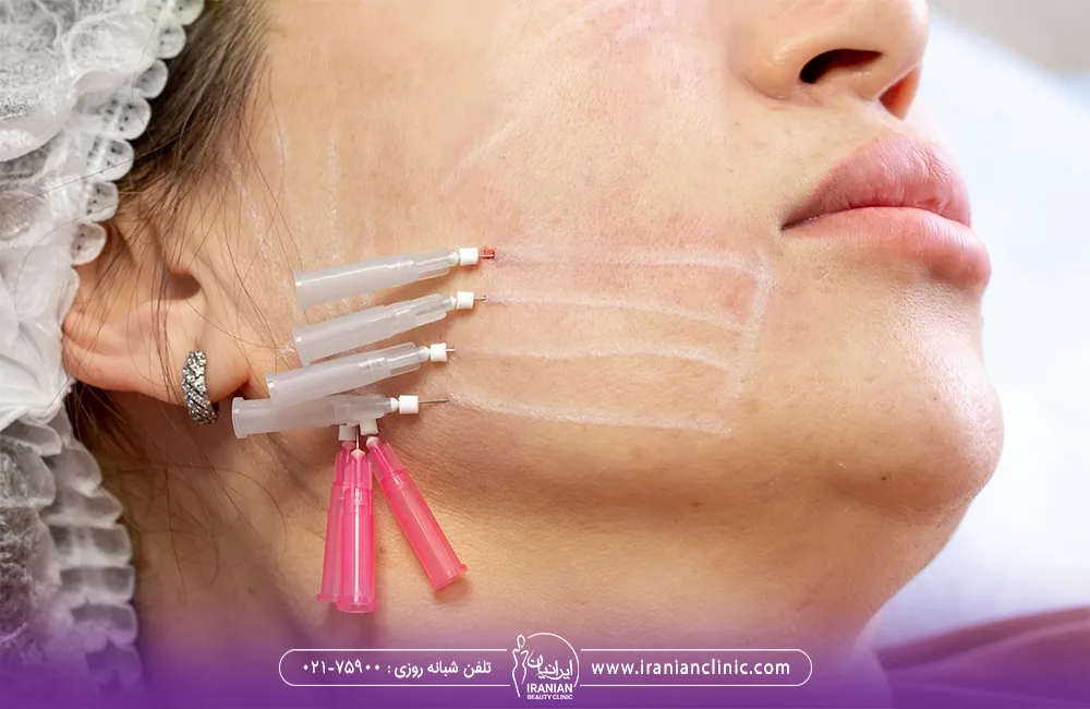 6 نخ لیفت در صورت زن جوان