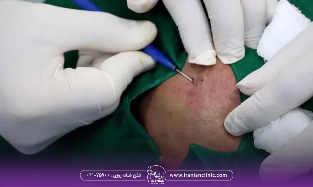 تصویر مربوط به یه بخش از صورت است که پزشکان روی اون قسمت در حال انجام سابسیژن هستن.