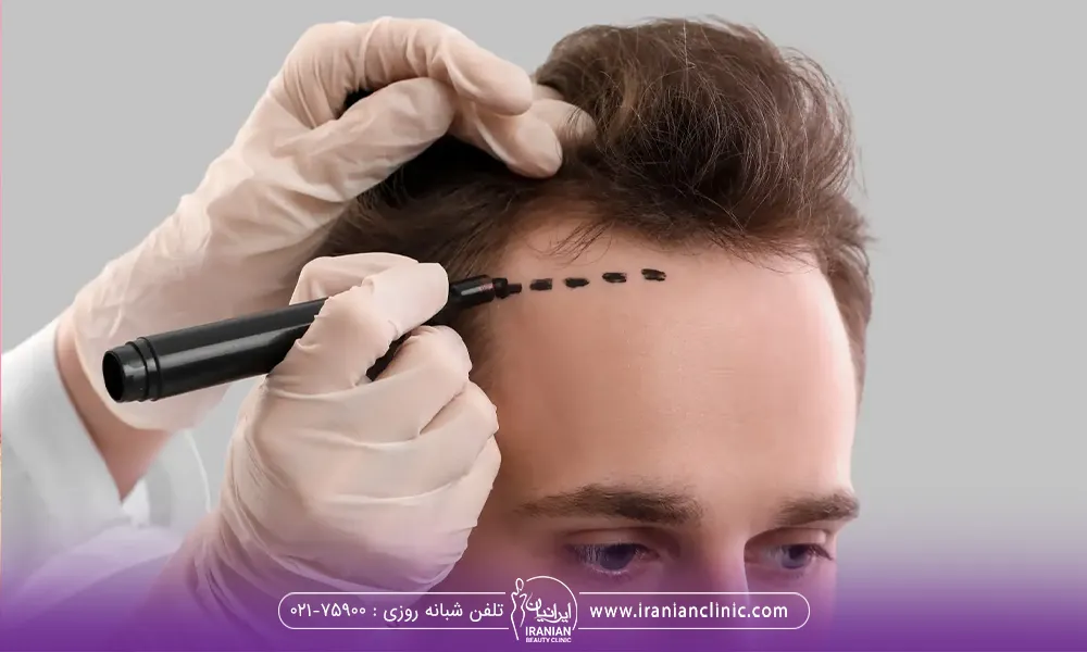 مردی که نشسته و میخواهد کاشت دائمی مو را توسط پزشک انجام میدهد