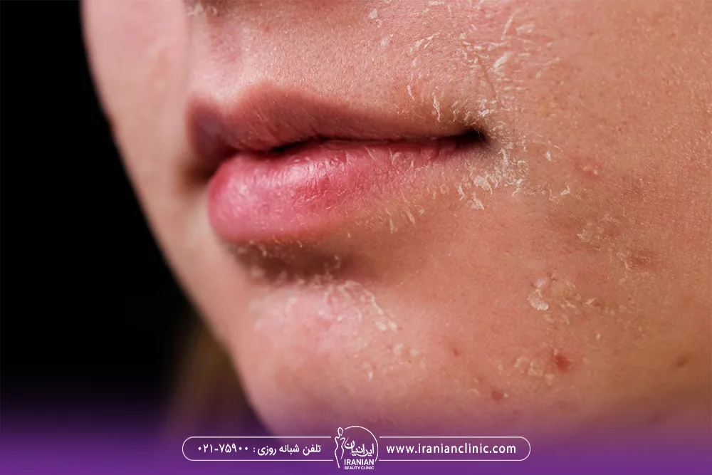 دختری که صورت او پوسته پوسته شده است - عوارض سابسیژن