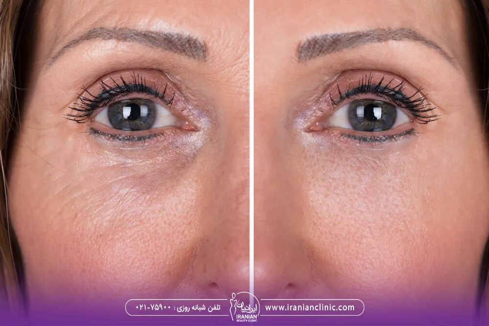 عکس قبل و بعد از نتایج تزریق ژل پروفایلو