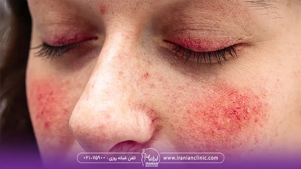 دختر که پوست صورت او قرمز شده است