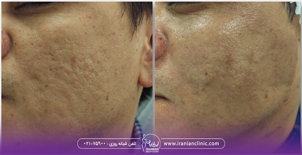 عکس قبل و بعد سابسیژن آکنه صورت - هزینه سابسیژن