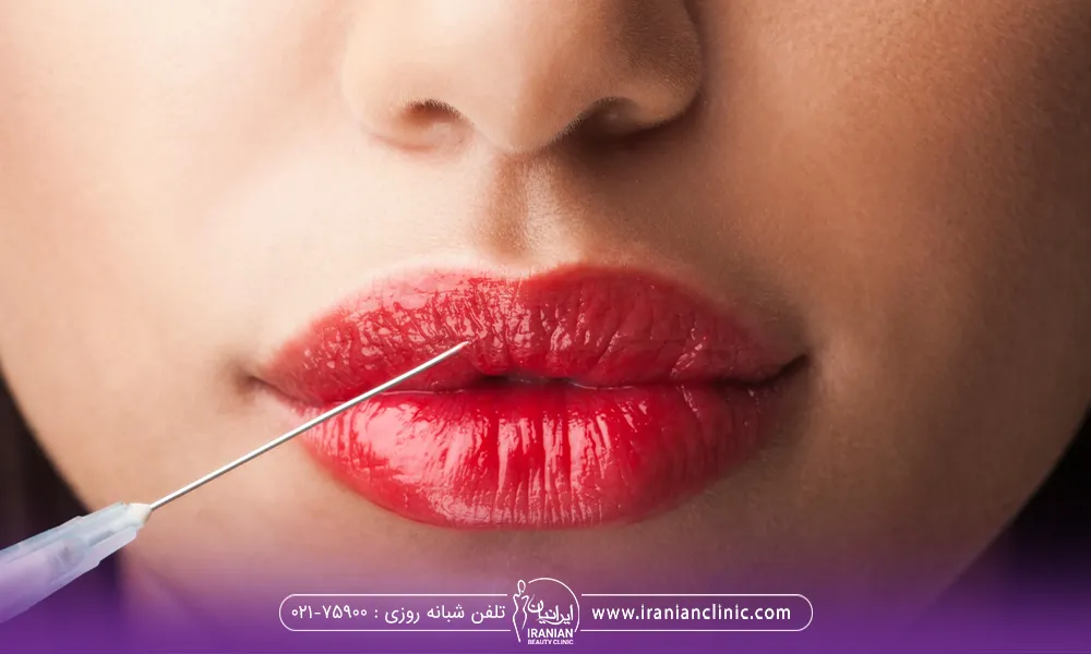 خانمی که رژلب قرمز زده است و در حال تزریق ژل لب میباشد و سوزن سرنگ هم روی لب این خانم قرار دارد