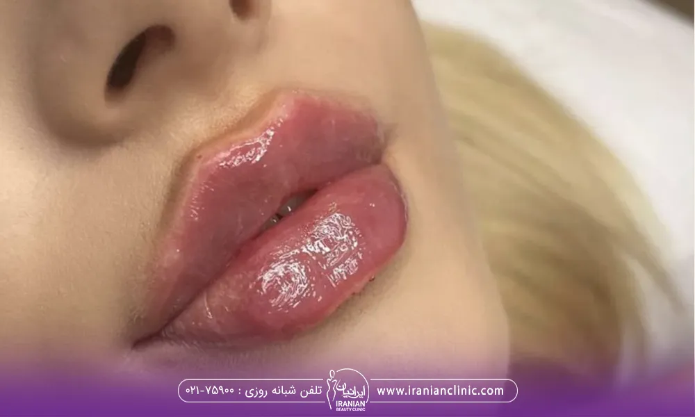 انجام تزریق ژل لب عروسکی