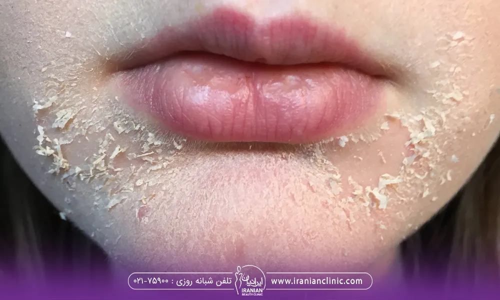 فردی که بعد از تزریق ژل دچار پوسته پوسته شدن پوست خود اطراف لب هایش میشود