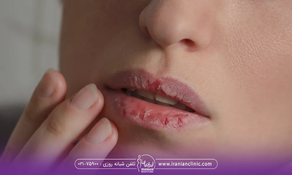 خانومیکه بعد از تزریق ژل لب لبهایش خشک شده و دستهایش را روی لبش گذاشته است