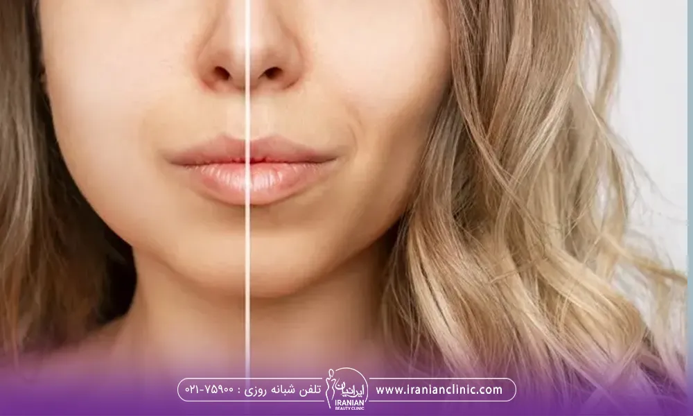 قبل و بعد از انجام زاویه سازی صورت گرد و چاق