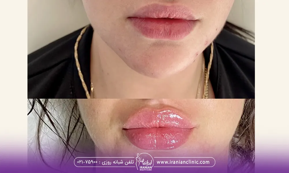 قبل و بعد لب یک خانم که تزریق ژل لب عروسکی انجام داده است