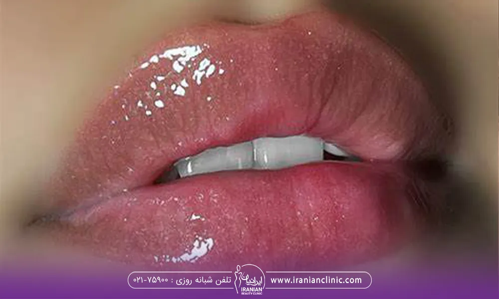 How much does lip gelrepair cost