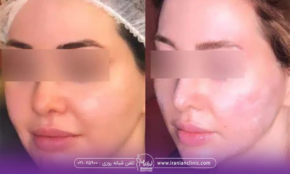 قبل و بعد از یک خانم که اندولیفیت را انجام داده است