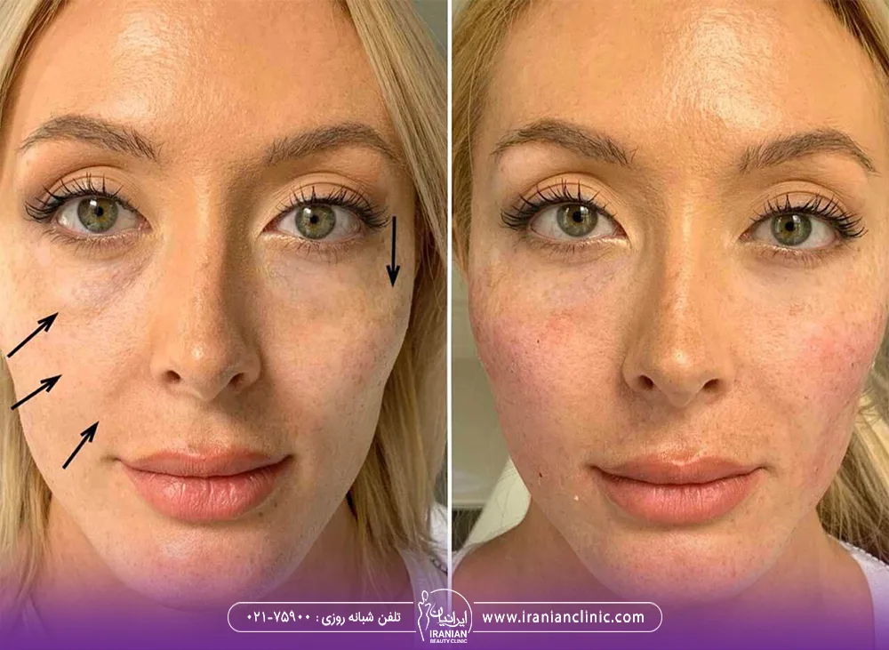 عکس قبل و بعد تزریق ژل به گونه زن
