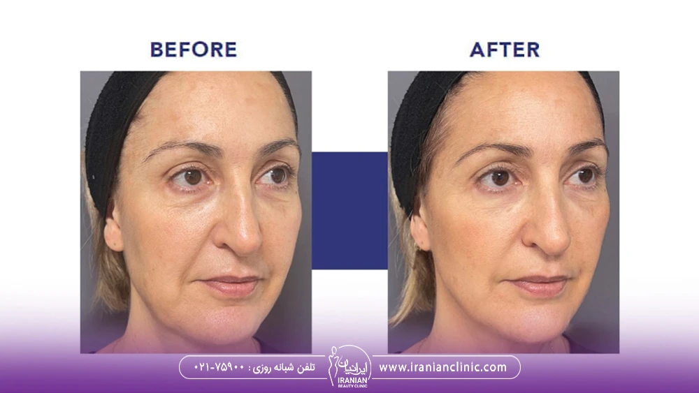 عکس قبل و بعد تزریق پروفایلو استراکچرا به صورت زن