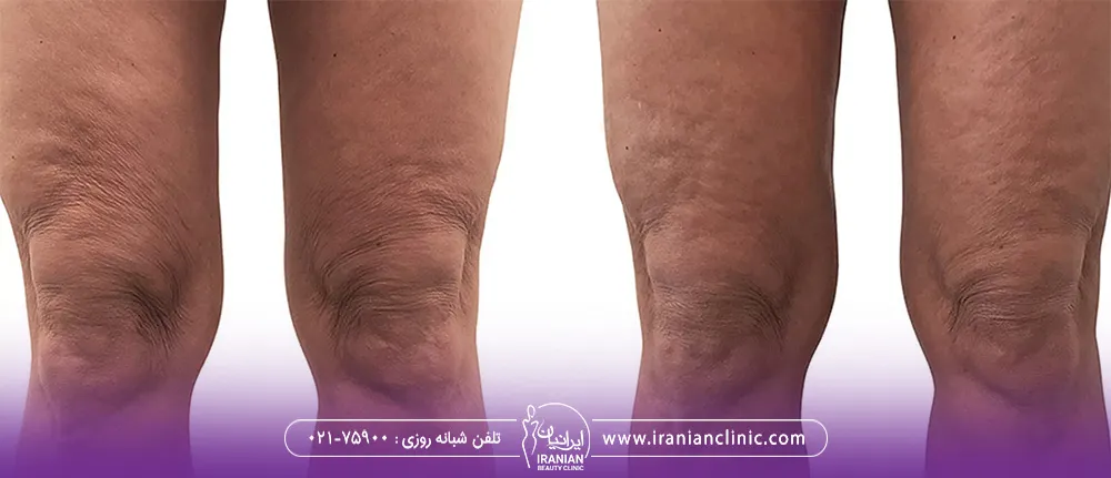 سلولیت های روی زانو است که با اندولیفت از بین رفته