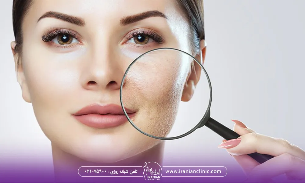 یک خانم است که با ذره بین روی پوستش منافذ باز صورتش زا نشان می دهد